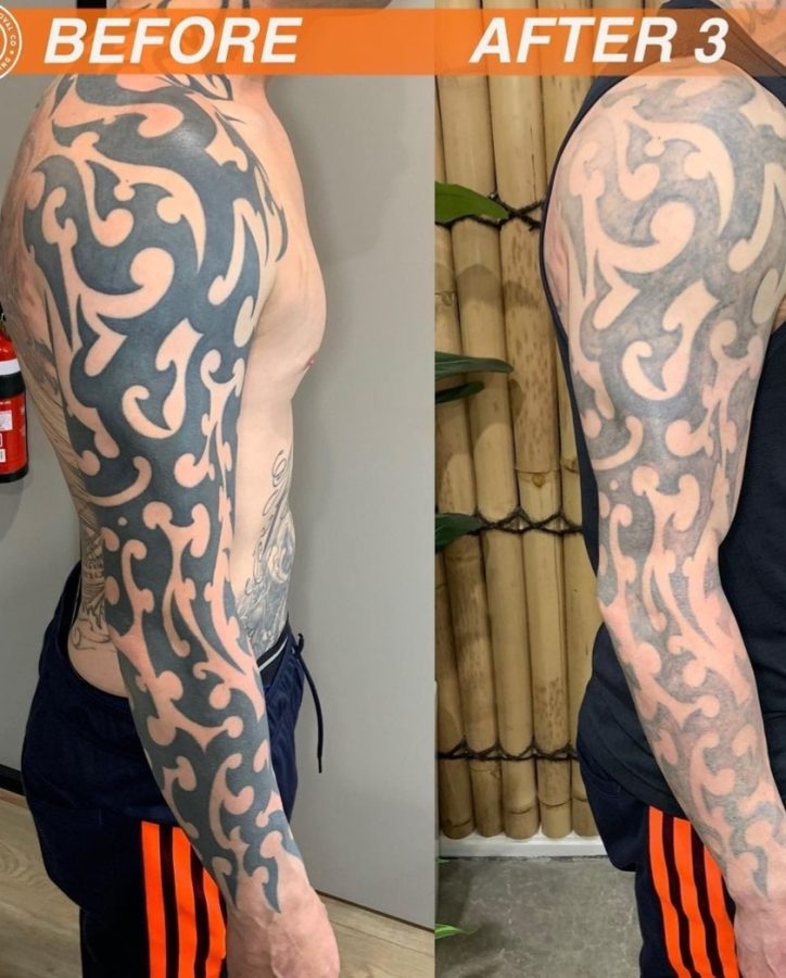 A before and after comparison of laser tattoo removal showing the slow progress of the process.